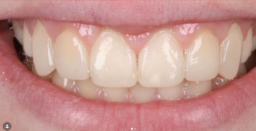 Crown Lengthening after treatment